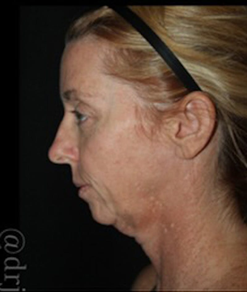 Face and Necklift Before & After Gallery - Patient 368217 - Image 3