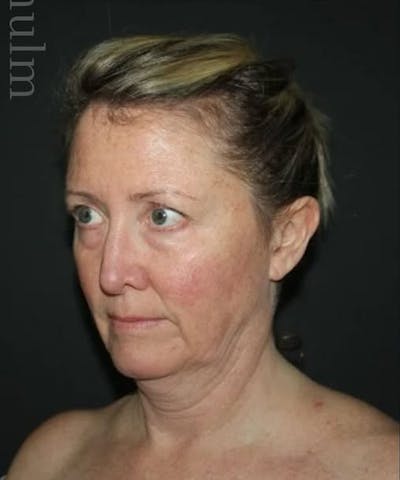 Face and Necklift Before & After Gallery - Patient 645585 - Image 1