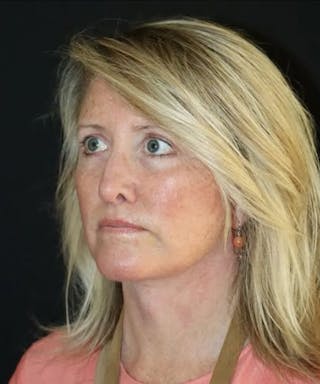 Face and Necklift Before & After Gallery - Patient 645585 - Image 2