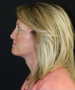 Face and Necklift Before & After Gallery - Patient 645585 - Image 4