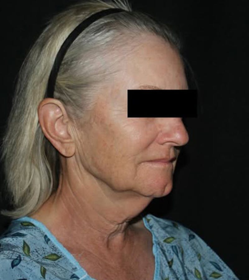 Face and Necklift Before & After Gallery - Patient 104293 - Image 1