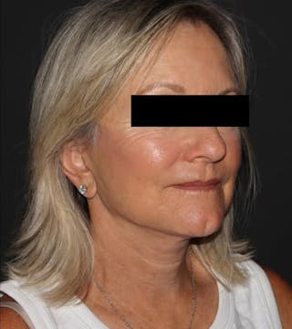 Face and Necklift Before & After Gallery - Patient 104293 - Image 2
