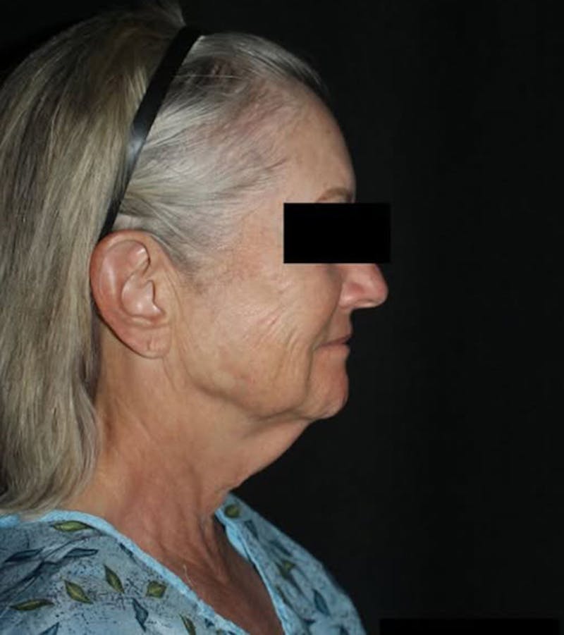 Face and Necklift Before & After Gallery - Patient 104293 - Image 3