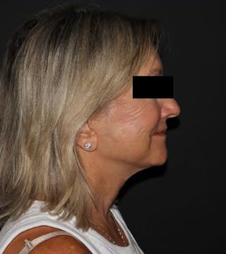 Face and Necklift Before & After Gallery - Patient 104293 - Image 4