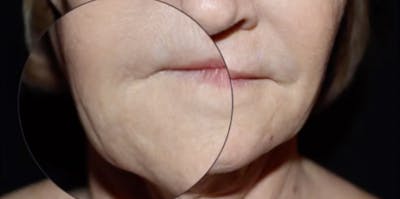 Face and Necklift Before & After Gallery - Patient 160043 - Image 1