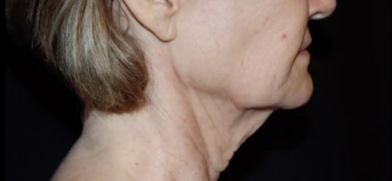 Face and Necklift Before & After Gallery - Patient 160043 - Image 3