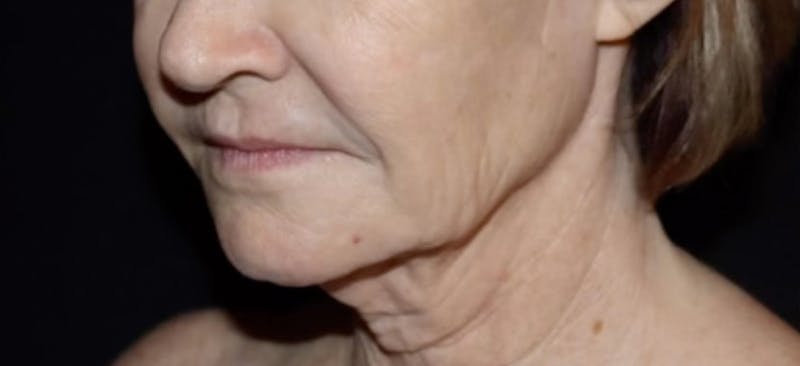 Face and Necklift Before & After Gallery - Patient 160043 - Image 5