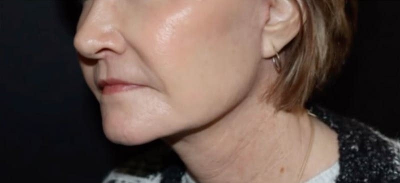 Face and Necklift Before & After Gallery - Patient 160043 - Image 6