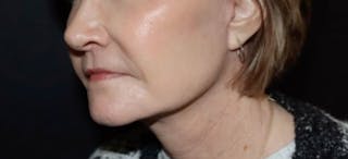 Face and Necklift Before & After Gallery - Patient 160043 - Image 6