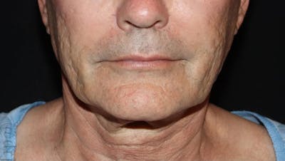 Face and Necklift Before & After Gallery - Patient 315415 - Image 1