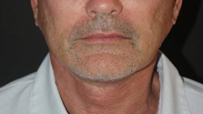 Face and Necklift Before & After Gallery - Patient 315415 - Image 2