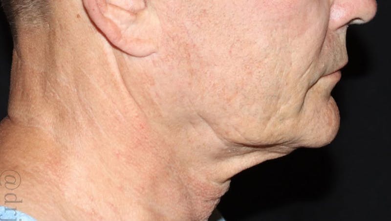 Face and Necklift Before & After Gallery - Patient 315415 - Image 3
