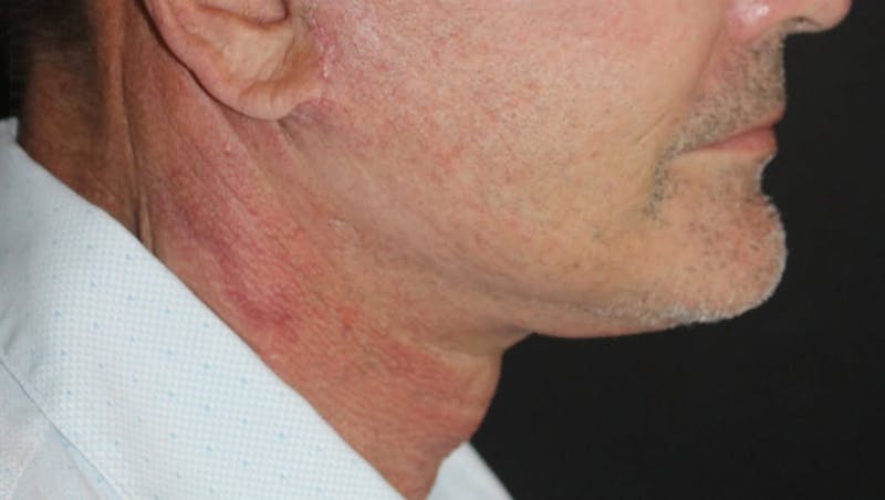 Face and Necklift Before & After Gallery - Patient 315415 - Image 4