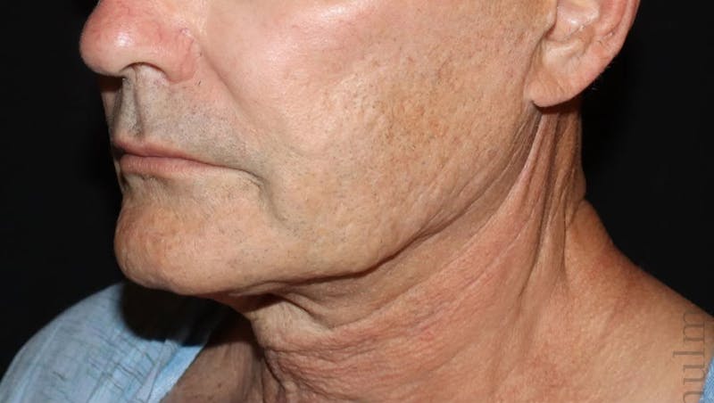 Face and Necklift Before & After Gallery - Patient 315415 - Image 5