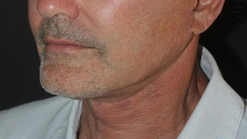 Face and Necklift Before & After Gallery - Patient 315415 - Image 6