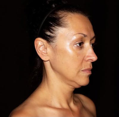 Face and Necklift Before & After Gallery - Patient 292761 - Image 1