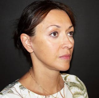 Face and Necklift Before & After Gallery - Patient 292761 - Image 2