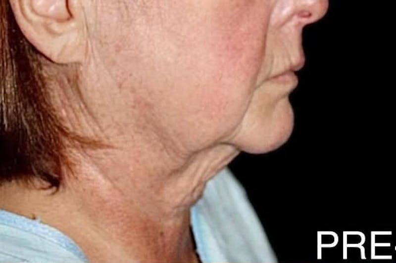 Face and Necklift Before & After Gallery - Patient 412284 - Image 1