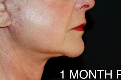 Face and Necklift Before & After Gallery - Patient 412284 - Image 2