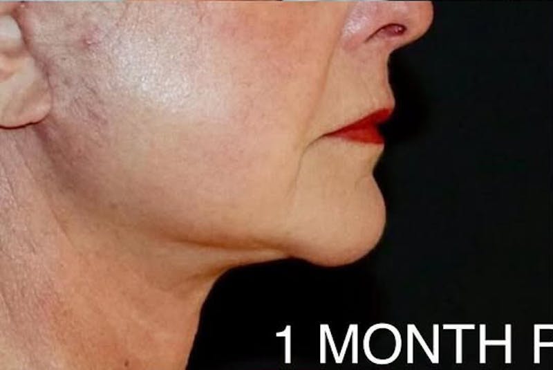 Face and Necklift Before & After Gallery - Patient 412284 - Image 2