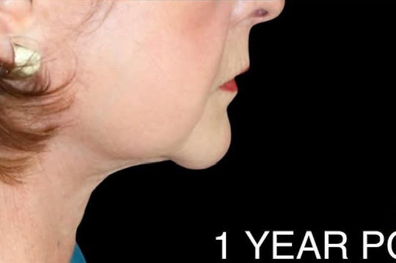 Face and Necklift Before & After Gallery - Patient 412284 - Image 4
