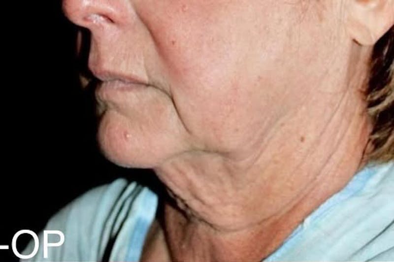 Face and Necklift Before & After Gallery - Patient 412284 - Image 5