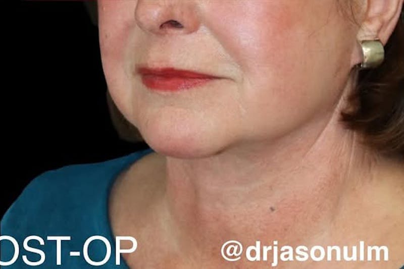 Face and Necklift Before & After Gallery - Patient 412284 - Image 7