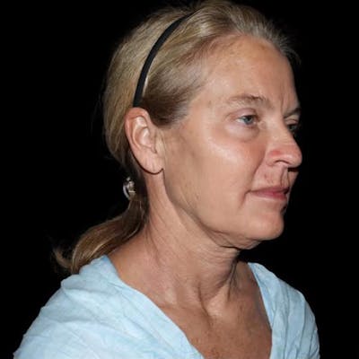 Face and Necklift Before & After Gallery - Patient 232264 - Image 1