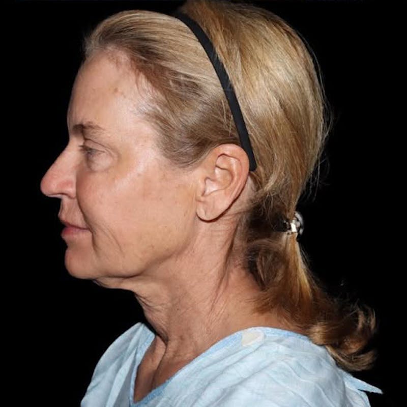 Face and Necklift Before & After Gallery - Patient 232264 - Image 3