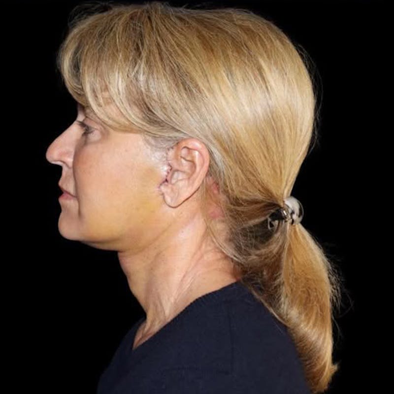 Face and Necklift Before & After Gallery - Patient 232264 - Image 4