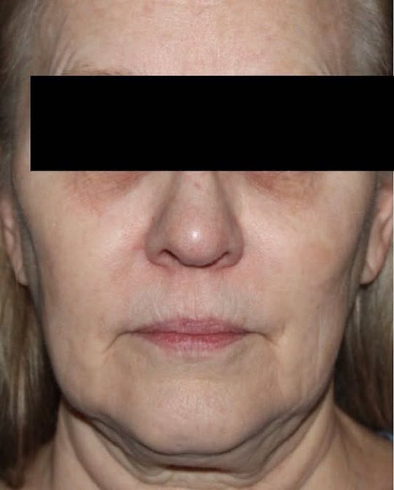 Face and Necklift Before & After Gallery - Patient 332605 - Image 1