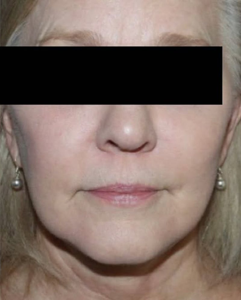 Face and Necklift Before & After Gallery - Patient 332605 - Image 2