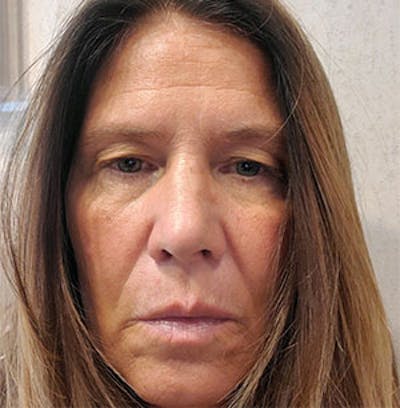Forehead Lift Before & After Gallery - Patient 370603 - Image 1