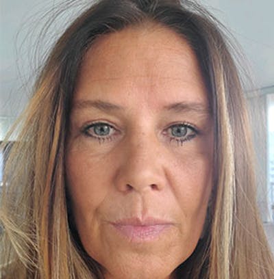 Forehead Lift Before & After Gallery - Patient 370603 - Image 2