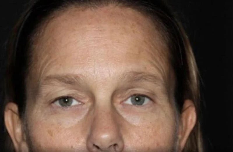 Eyelid Surgery Before & After Gallery - Patient 541250 - Image 1