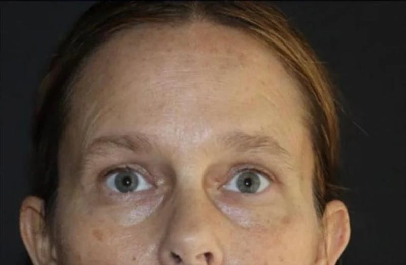Eyelid Surgery Before & After Gallery - Patient 541250 - Image 2