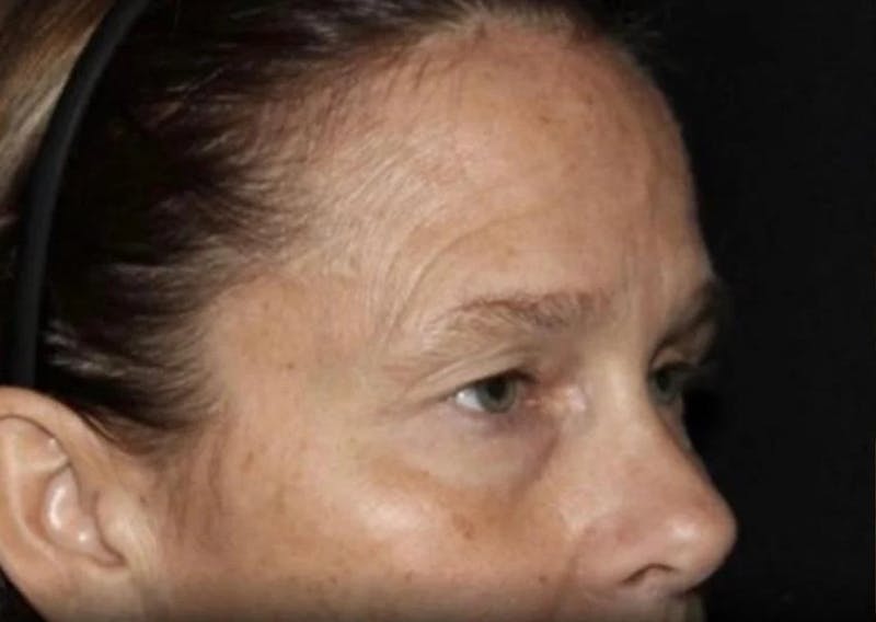 Eyelid Surgery Before & After Gallery - Patient 541250 - Image 3