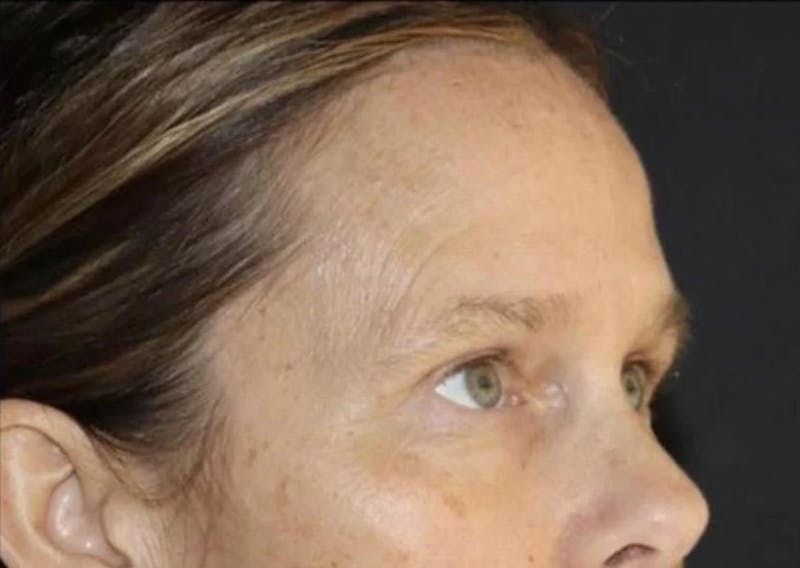 Eyelid Surgery Before & After Gallery - Patient 541250 - Image 4