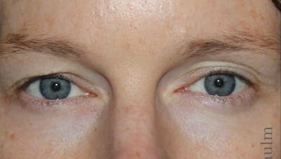 Eyelid Surgery Before & After Gallery - Patient 104791 - Image 1