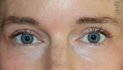 Eyelid Surgery Before & After Gallery - Patient 104791 - Image 2