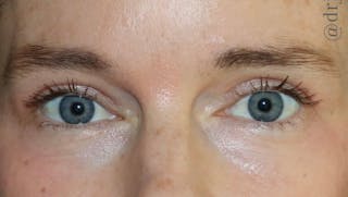 Eyelid Surgery Before & After Gallery - Patient 104791 - Image 2
