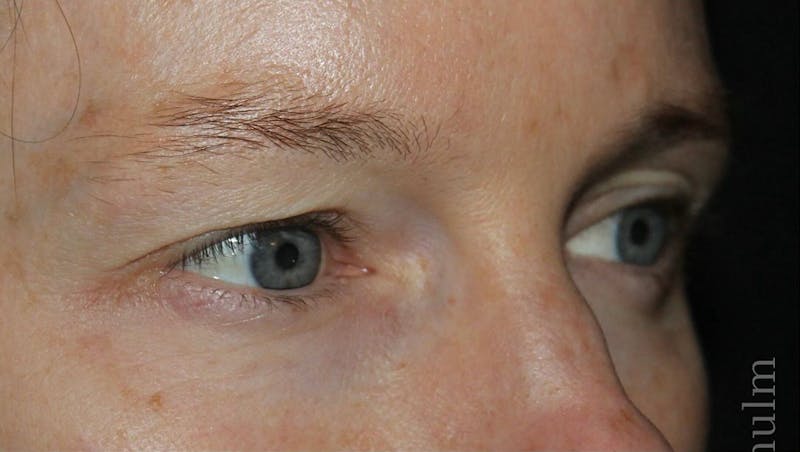 Eyelid Surgery Before & After Gallery - Patient 104791 - Image 3