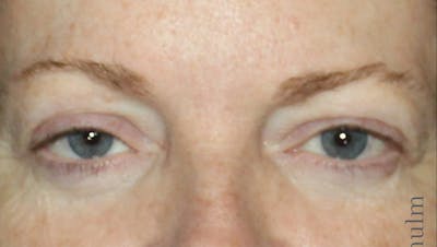 Eyelid Surgery Before & After Gallery - Patient 425408 - Image 1