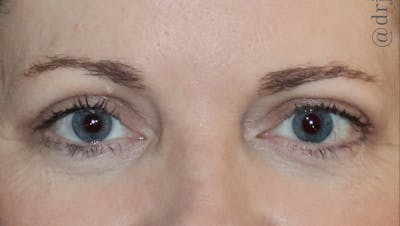 Eyelid Surgery Before & After Gallery - Patient 425408 - Image 2
