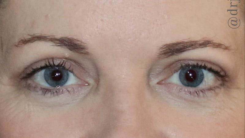 Eyelid Surgery Before & After Gallery - Patient 425408 - Image 2