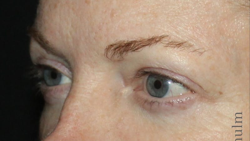 Eyelid Surgery Before & After Gallery - Patient 425408 - Image 3