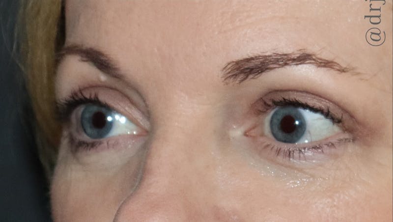Eyelid Surgery Before & After Gallery - Patient 425408 - Image 4