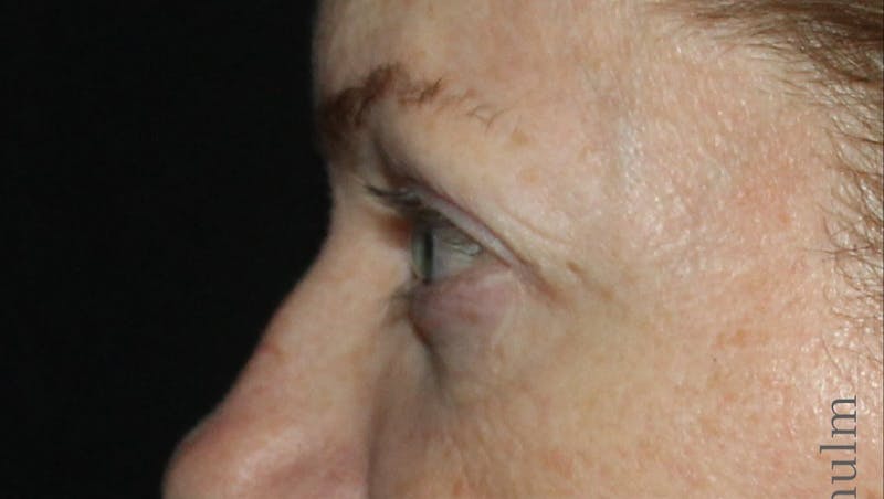 Eyelid Surgery Before & After Gallery - Patient 425408 - Image 5
