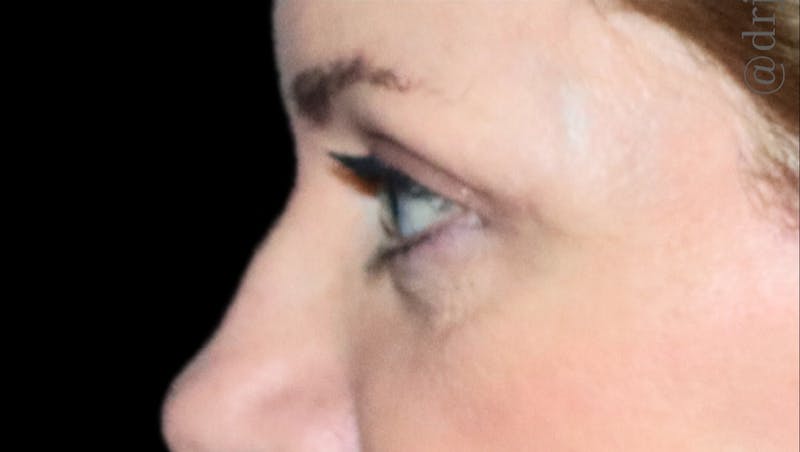 Eyelid Surgery Before & After Gallery - Patient 425408 - Image 6