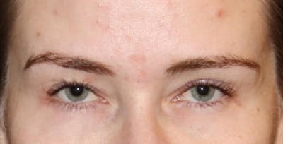 Eyelid Surgery Before & After Gallery - Patient 327447 - Image 1